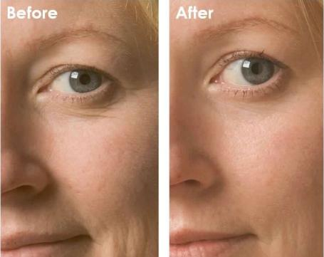 hyperbaric_oxygen_therapy_for_wrinkles.png hyperbaric_oxygen_therapy_for_wrinkles.png